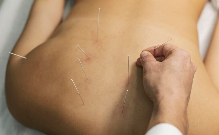 Acupuncture Therapy