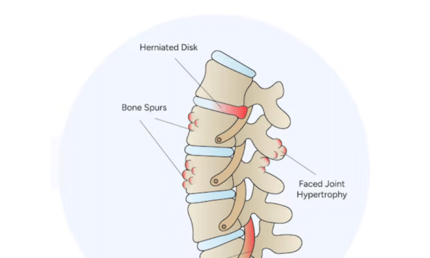 Understanding what causes Spinal Stenosis: Treatments, and Exercises